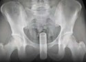Homem tenta coçar as costas com cabo de vassoura, mas acidente inusitado ocorre