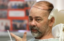 Médicos americanos realizam o primeiro transplante de crânio da história