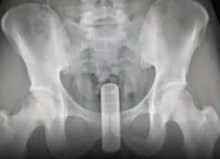 Homem tenta coçar as costas com cabo de vassoura, mas acidente inusitado ocorre