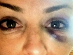 Tatiana, a ex-noiva do deputado, após a agressão