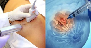 "Biópsia da mama”: Conheça mais este procedimento