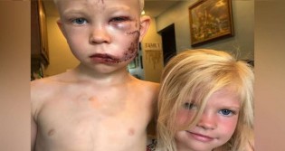 Menino de 6 anos salva irmã mais nova de ataque de cão e fica com o rosto desfigurado