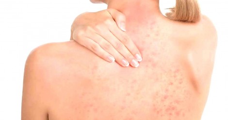 Dermatite: O que é e como evitá-la