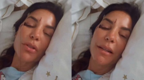 Ivete Sangalo é internada em Hospital e aparece com hematomas no rosto